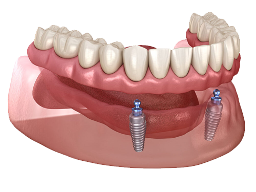 Implant Overdenture
